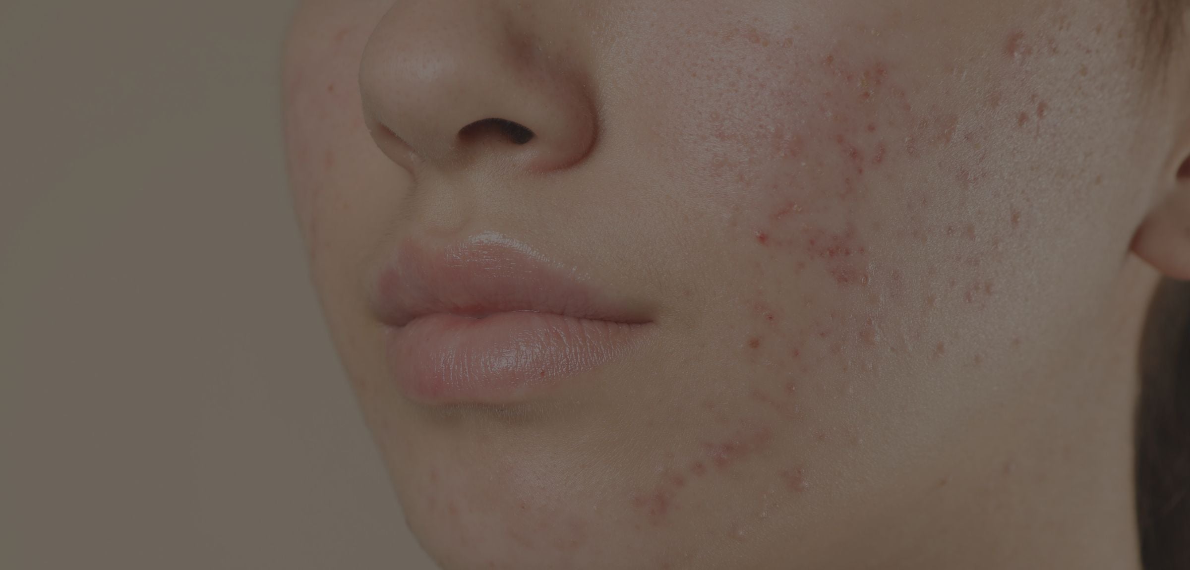 Extreme close-up of a person's lower face showing facial skin with visible red acne blemishes and pores, against a plain beige background.